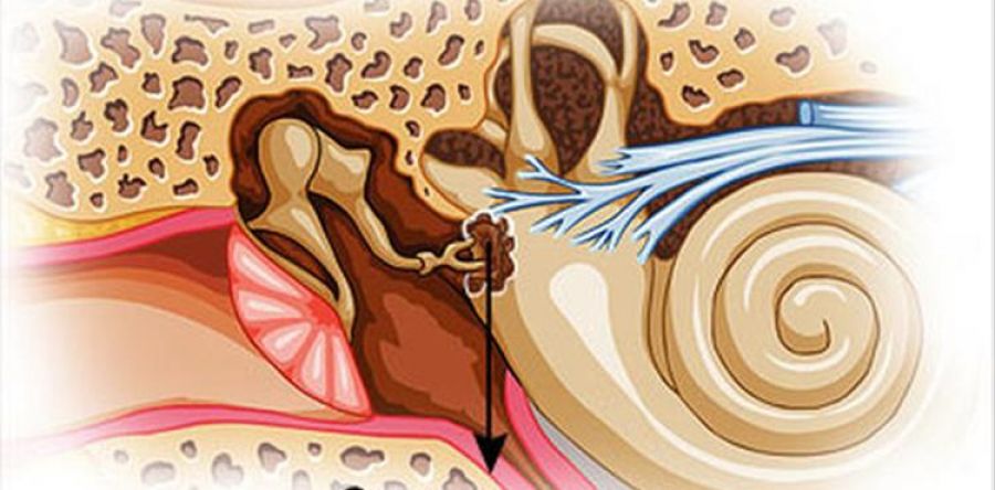 Calcification of Ear Bones (Otosclerosis) - İDOL KBB